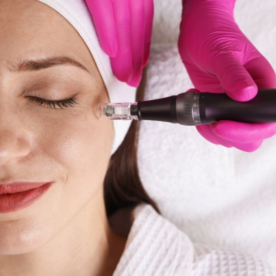 Microneedling on skin