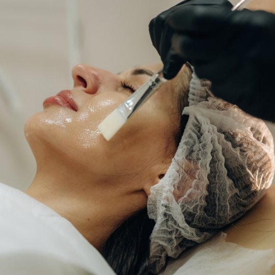 VI Chemical Peel beingh applied to skin